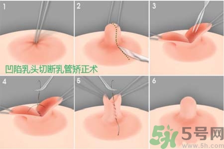 乳頭內(nèi)陷怎么矯正？乳頭內(nèi)陷矯正方法是什么？