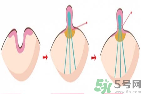 乳頭內(nèi)陷矯正需注意什么？乳頭內(nèi)陷如何預(yù)防？