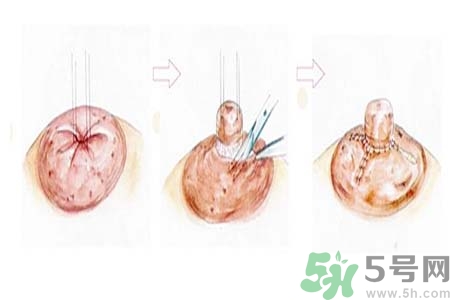 乳頭內(nèi)陷矯正需注意什么？乳頭內(nèi)陷如何預(yù)防？