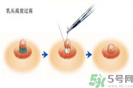 乳頭內(nèi)陷能不能喂奶？乳頭凹陷怎樣哺乳？