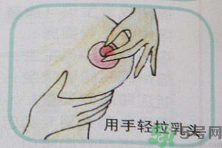 乳頭內(nèi)陷可以拔罐嗎？乳頭內(nèi)陷需要手術(shù)治療嗎？