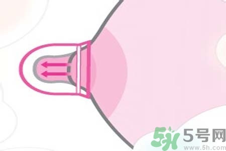 乳頭內(nèi)陷可以拔罐嗎？乳頭內(nèi)陷需要手術(shù)治療嗎？