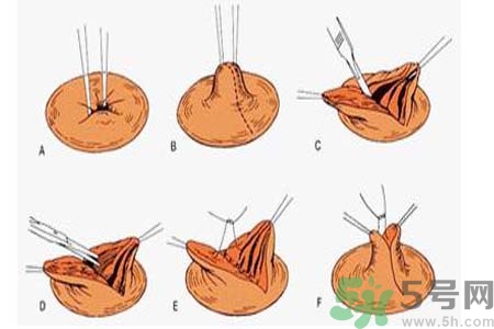 乳頭內(nèi)陷可以拔罐嗎？乳頭內(nèi)陷需要手術(shù)治療嗎？