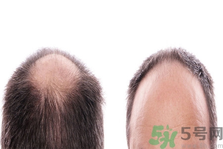 頭發(fā)稀少的原因是什么？如何預(yù)防禿頂?shù)陌l(fā)生？