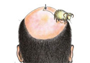 禿頂會遺傳嗎？治療禿頂?shù)姆椒ㄊ鞘裁矗?><p><strong>禿頂會遺傳嗎？治療禿頂?shù)姆椒ㄊ鞘裁矗?/strong></p></a></li> </ul>
</div>
<div   id=