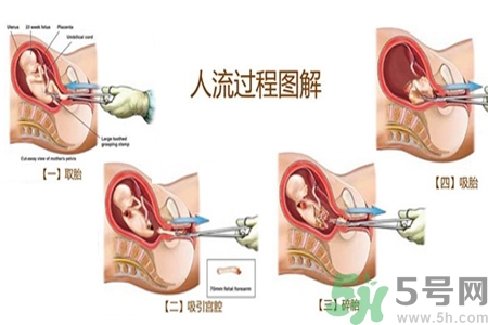 人工流產后多久可以再次懷孕？流產后需要注意什么？