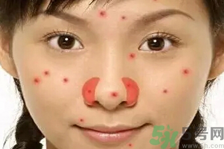 鼻翼長痘痘怎么回事？鼻翼長痘痘的原因是什么？