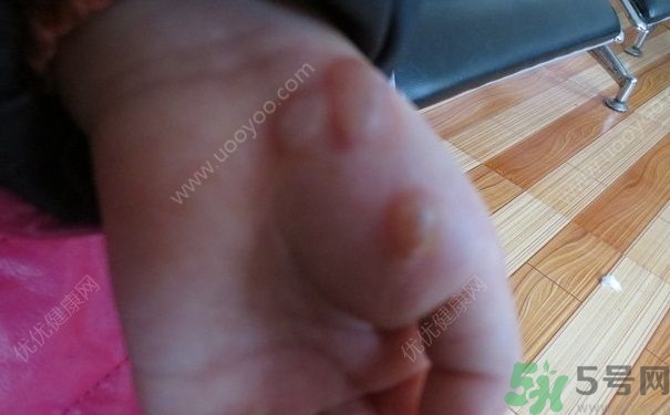 15歲還會得手足口病嗎？手足口病的癥狀有哪些？