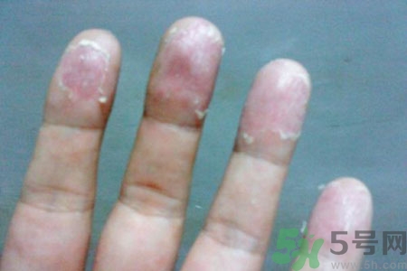 ?手掌脫皮的危害有哪些？如何預(yù)防手掌脫皮？
