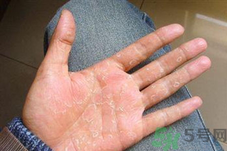 ?手掌脫皮的危害有哪些？如何預(yù)防手掌脫皮？