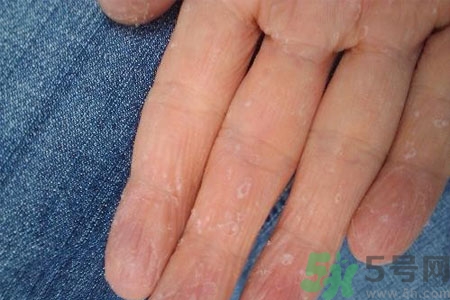 ?手掌脫皮的危害有哪些？如何預(yù)防手掌脫皮？