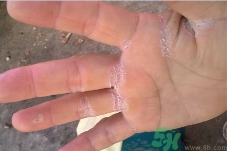 手脫皮是什么原因？手脫皮的治療方法是什么？