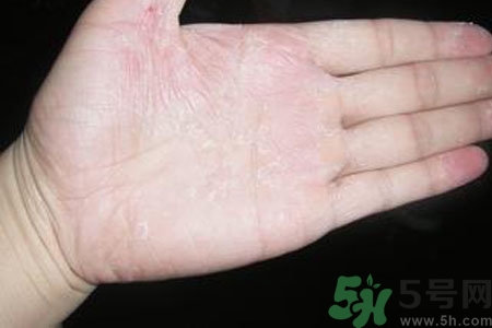 手脫皮是什么原因？手脫皮的治療方法是什么？