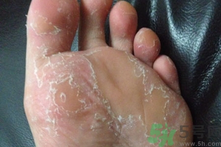 腳脫皮是怎么回事？腳脫皮怎么辦？