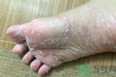 腳脫皮的治療方法有哪些？如何預(yù)防腳脫皮？