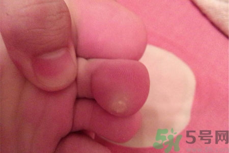 雞眼如何去除？腳上長了雞眼怎么治療？