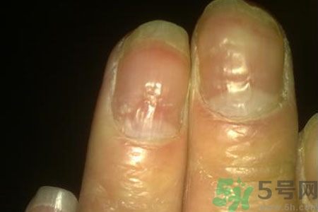 孩子手指甲凹凸不平是什么原因？手指甲凹凸不平的原因是什么？