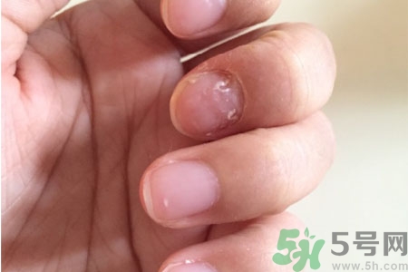 孩子手指甲凹凸不平是什么原因？手指甲凹凸不平的原因是什么？