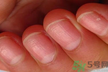 手指甲凹凸不平是怎么回事？如何預(yù)防手指甲凹凸不平？