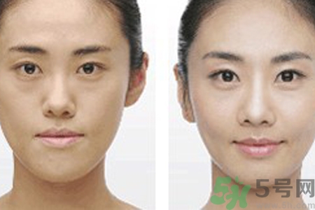 激光縮毛孔多少錢一次？激光縮毛孔一個療程多少錢？