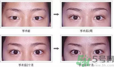 提眉術后多久可以恢復？提眉術后全過程照片