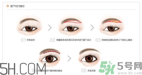 切眉手術(shù)后老得快嗎？切眉能保持多久？