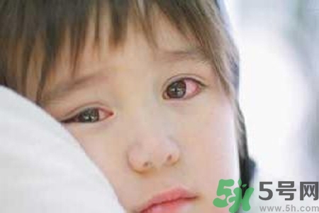 流行性腮腺炎的表現(xiàn)有哪些？?流行性腮腺炎飲食怎么調(diào)理？