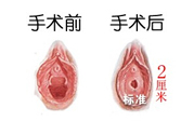 處女膜修補(bǔ)術(shù)效果怎么樣？處女膜修復(fù)手術(shù)有風(fēng)險(xiǎn)嗎？