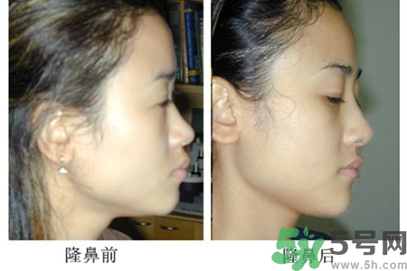 玻尿酸隆鼻的危害有哪些？玻尿酸隆鼻的副作用是什么？