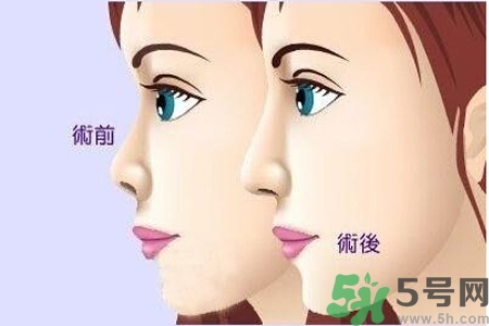 玻尿酸隆鼻的缺點是什么？玻尿酸隆鼻的優(yōu)點有哪些？