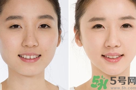玻尿酸隆鼻的缺點是什么？玻尿酸隆鼻的優(yōu)點有哪些？
