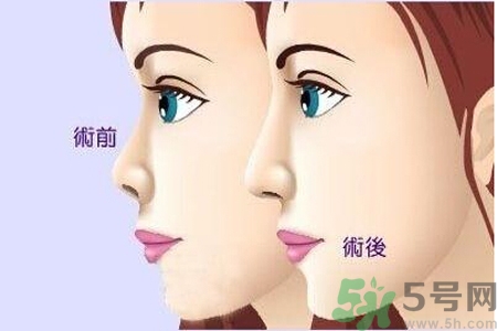 玻尿酸隆鼻和手術(shù)隆鼻的區(qū)別是什么？