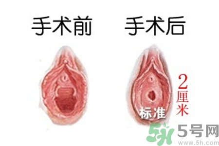 什么人不能做處女膜修補術(shù)？處女膜修補術(shù)會留疤嗎？