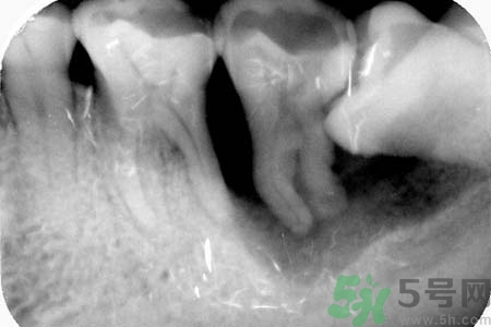 拔智齒一顆多少錢(qián)？拔除智齒收費(fèi)多少？