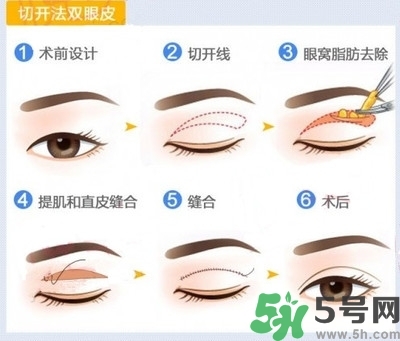 雙眼皮手術(shù)哪種最好？割雙眼皮后注意些什么？