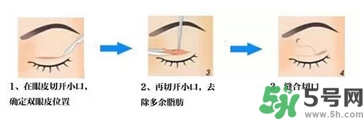 雙眼皮手術(shù)哪種最好？割雙眼皮后注意些什么？
