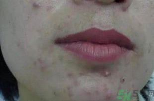 什么樣的痘痘能擠？哪些痘痘不能擠？