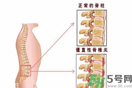 僵直性脊椎炎的癥狀有哪些？怎樣預(yù)防僵直性脊椎炎？