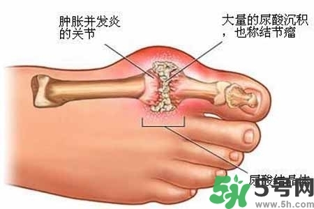 引發(fā)痛風(fēng)的原因是什么？痛風(fēng)病人飲食需注意什么好？