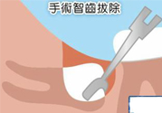 智齒拔完后有個洞怎么辦？拔智齒后有個洞多久能長好？