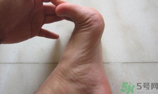 腳拇指外翻遺傳嗎？腳拇指外翻怎么矯正？