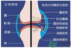 骨關(guān)節(jié)炎能治好嗎？骨關(guān)節(jié)炎平時注意事項