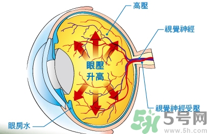 青光眼可以治愈嗎？青光眼怎樣治療？