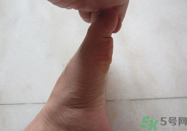 腳拇指外翻遺傳嗎？腳拇指外翻怎么矯正？