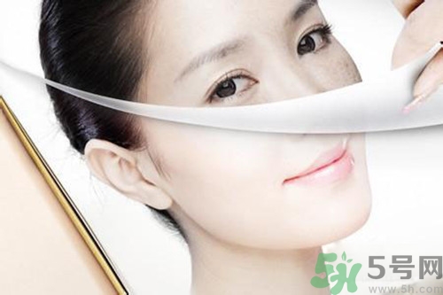 曬斑可以自己消退嗎？曬斑可以用激光去除嗎？