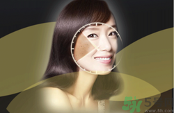 曬斑可以自己消退嗎？曬斑可以用激光去除嗎？
