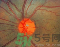 青光眼可以治愈嗎？青光眼怎樣治療？