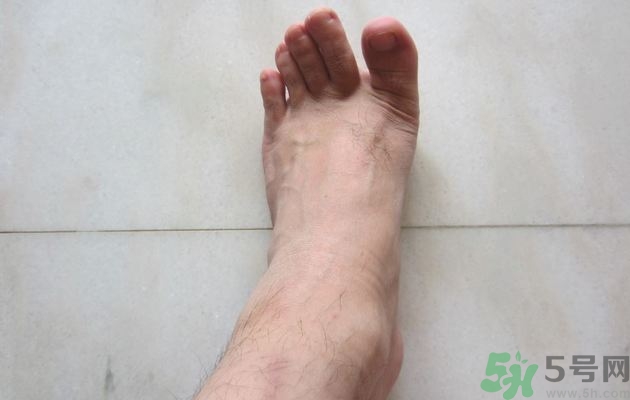 腳拇指外翻遺傳嗎？腳拇指外翻怎么矯正？