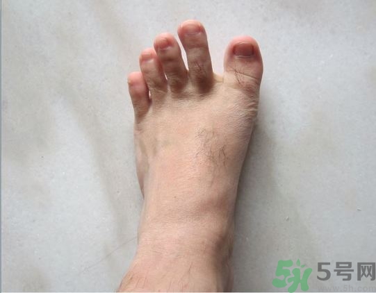 腳拇指外翻遺傳嗎？腳拇指外翻怎么矯正？