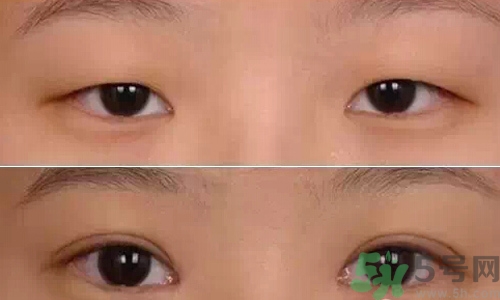 天生腫眼泡怎么消除？天生腫眼泡怎么辦？